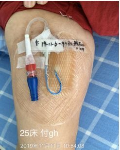 picc0揭敷料Ω固定法好经验快收藏