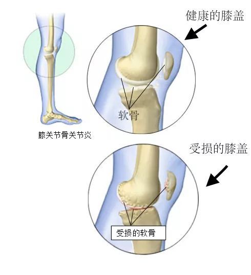 被保守治疗拖延了三四年 我爹终于换上了人工关节 腾讯新闻