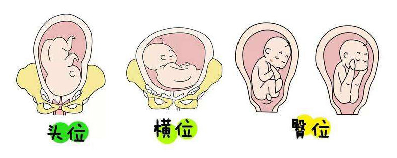 怀孕七个月胎儿是横位还能顺产吗一个动作纠正胎位不正