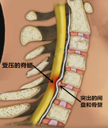 不知道这3 类颈椎病手术 你还敢做手术 腾讯新闻