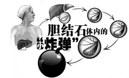 无症状胆结石能否撒手不管呢 警惕人体内的 定时炸弹 腾讯新闻