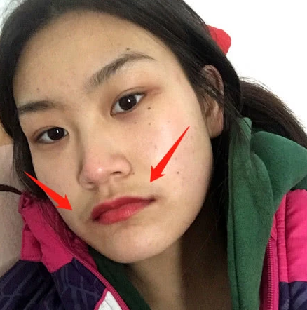 为何有些女生的嘴唇上长出一圈"胡子"?专家直言:无非是这3个原因