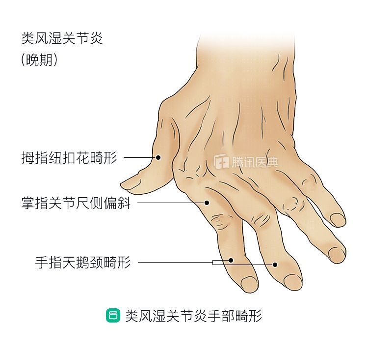 类风湿关节炎初期能治愈吗 杨铁生医生视频讲解风湿免疫内科疾病 快速问医生