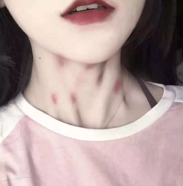 给脖子"种草莓",真的有这么多危害?"啵啵"时的禁忌,下口需谨慎?