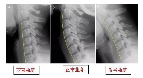 低头伏案工作时间长 颈椎生理曲度异常该怎么办 专家为您支招 腾讯新闻