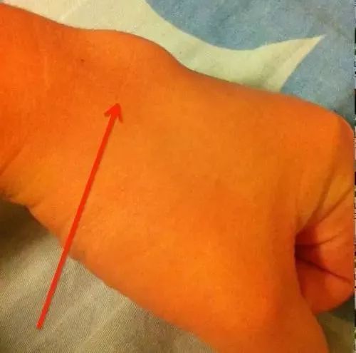 身体各处的筋疙瘩筋结对应五脏的疾病一招通调