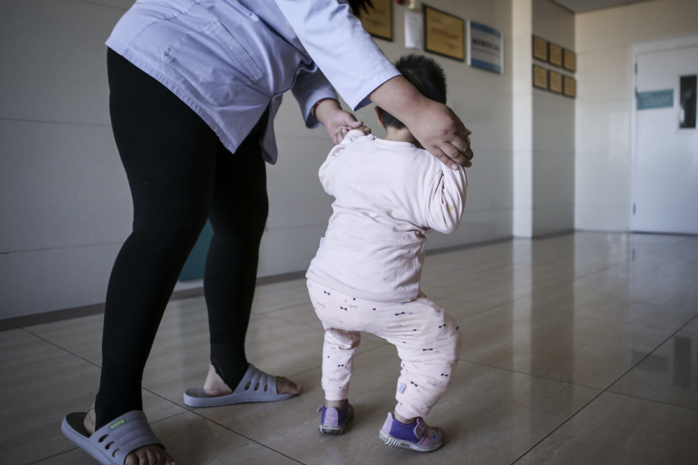 1岁女童不幸掉进开水锅烫成重伤四肢畸形走路形似瘸腿鸭子