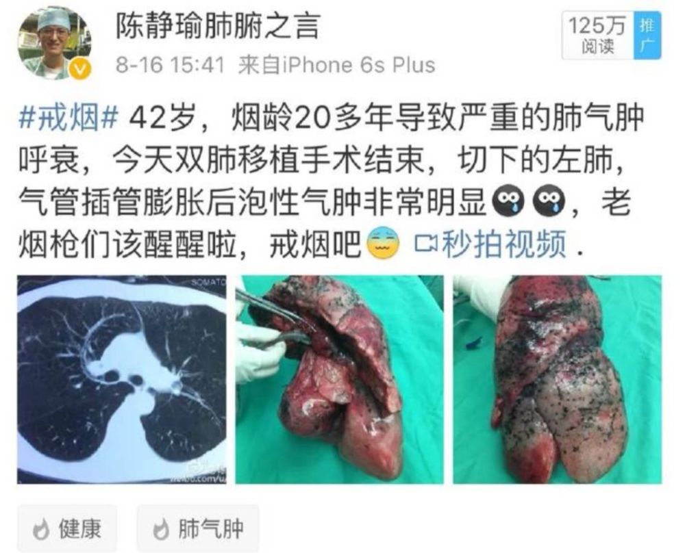 史上最硬核戒烟广告30年烟龄男子捐肺医生取出后不敢用
