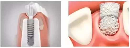 骨粉是什么?做种植牙为什么还要植骨?