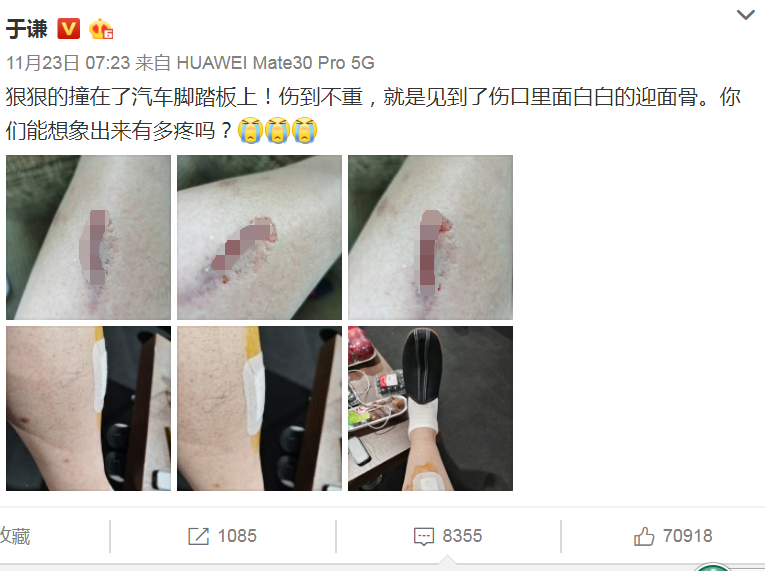 突发德云社知名相声演员于谦出车祸伤口画面曝光