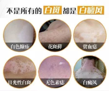 贵阳白癜风医院：为美丽重启希望之门