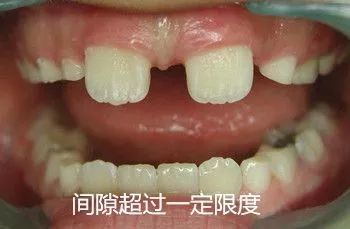 孩子大板牙怎么办?|孩子|牙齿