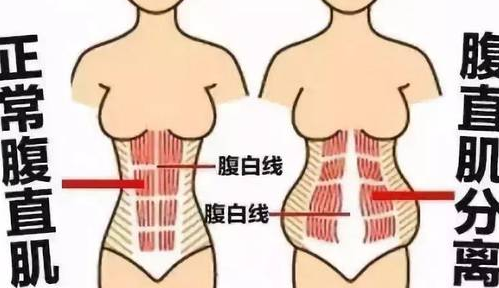 产后不做小腹婆腹直肌分离这些后果你能承受吗