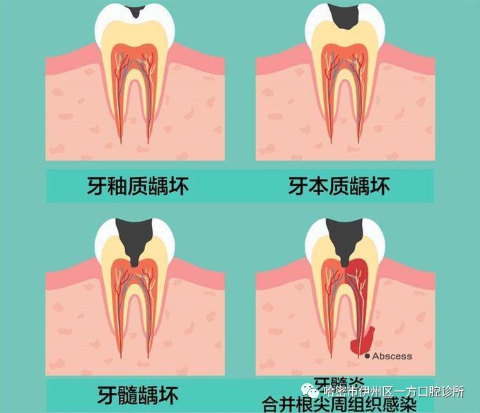 牙釉質,牙本質和牙骨質在咀嚼時主要起承擔咀嚼力,碾磨食物的作用,牙