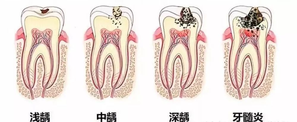 龋齿洞型分类6类图片