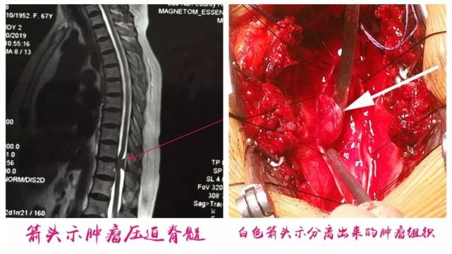 神经外科新技术让患者重获新生