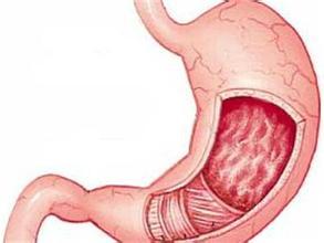 萎缩越严重,肠化就越严重?