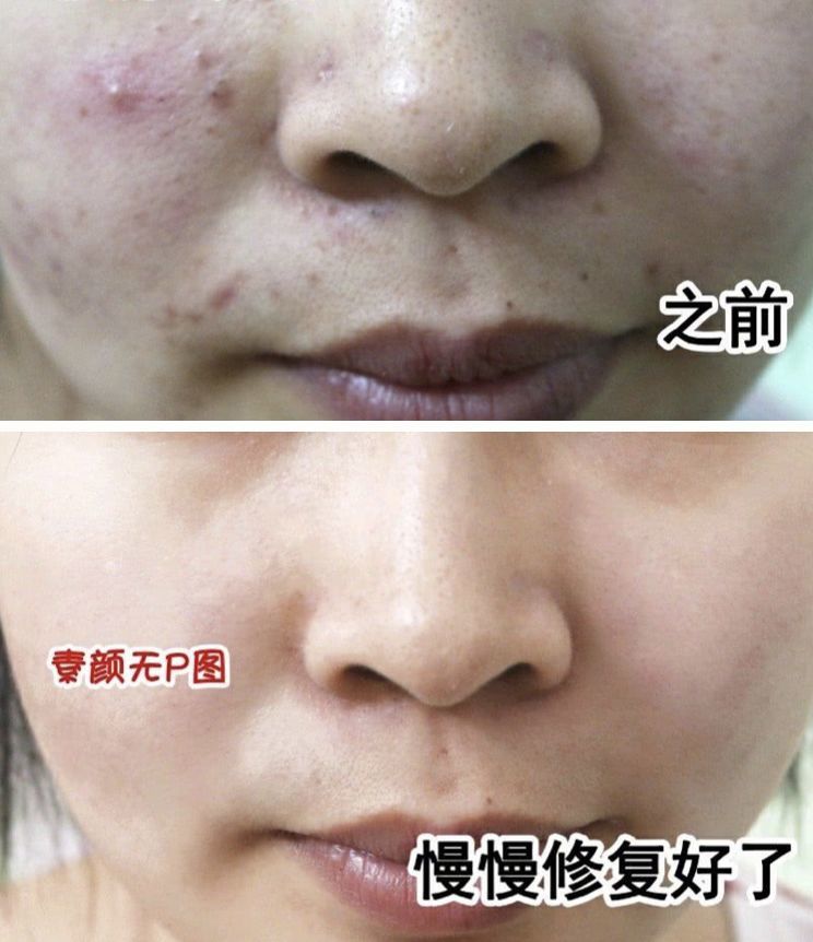 一样 果蔬精华帮助减少皮下细菌滋生与污垢沉积 排出皮下痘疮"垃圾"