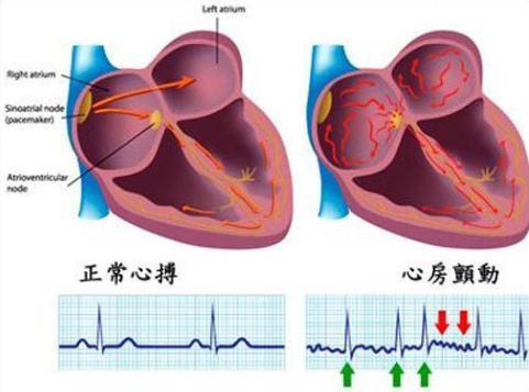 名医专访武汉同济医院心血管内科王炎房颤的诊断和治疗