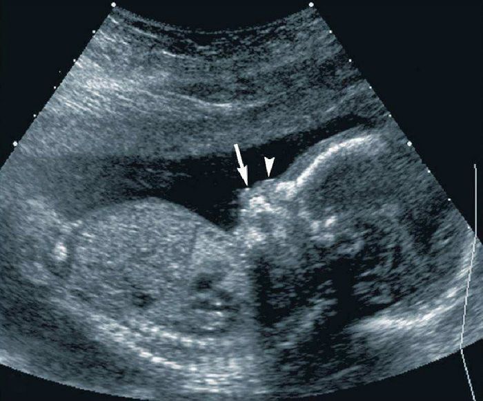 做四维彩超时,胎儿一直"微笑",孕妈欣喜,医生:最好别生下来