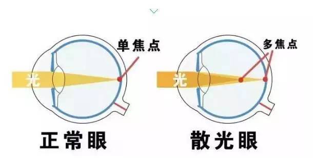 徐州近视手术:散光是一种什么感觉?