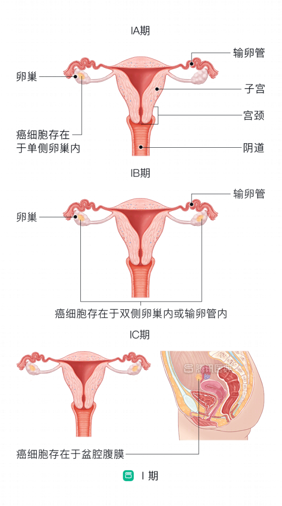 这种癌症最容易光顾女性子宫 专家提醒 做好这4点 才能赶跑它 腾讯新闻