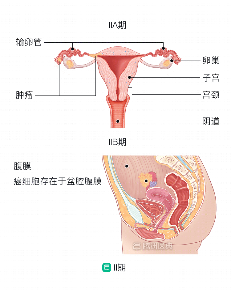 人体子宫平面图图片