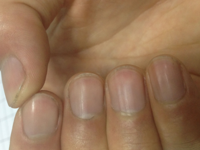 为何指甲上会无故有竖纹或是身体在暗示这3种情况别忽视