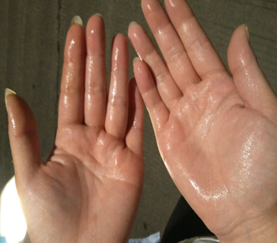 资深的汗手怎样防止手出汗呢