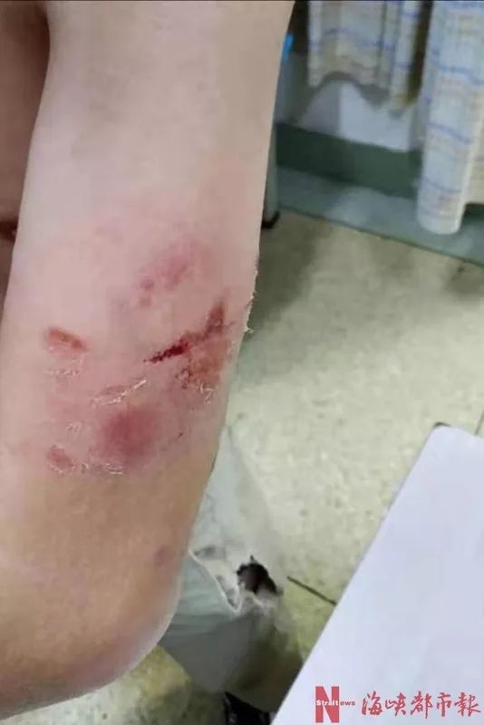 福州一小区,恶犬蹿出别墅,咬得邻居伤痕累累!