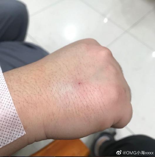 在小海发布的微博中我们可以看到,由于护士的失误小海的手似乎肿的有