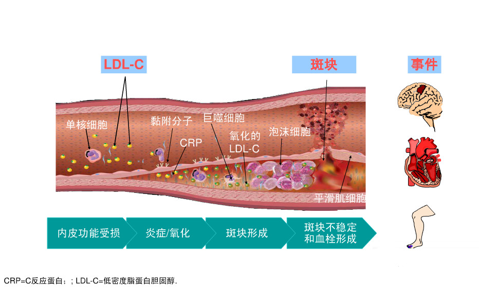 他汀类药物要吃多久才能对动脉粥样硬化斑块产生逆转作用