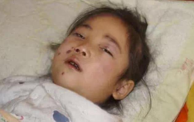 白血病不是突然来临的不论男女孩子有这3迹象时家长要重视