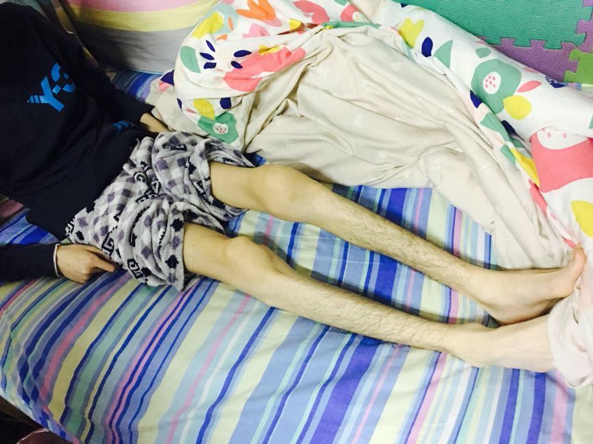 骨瘦如柴的小宇,172cm的个子只有80斤  图片由患者家属提供对于小宇