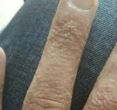 那么水疱疹是如何发生的呢?