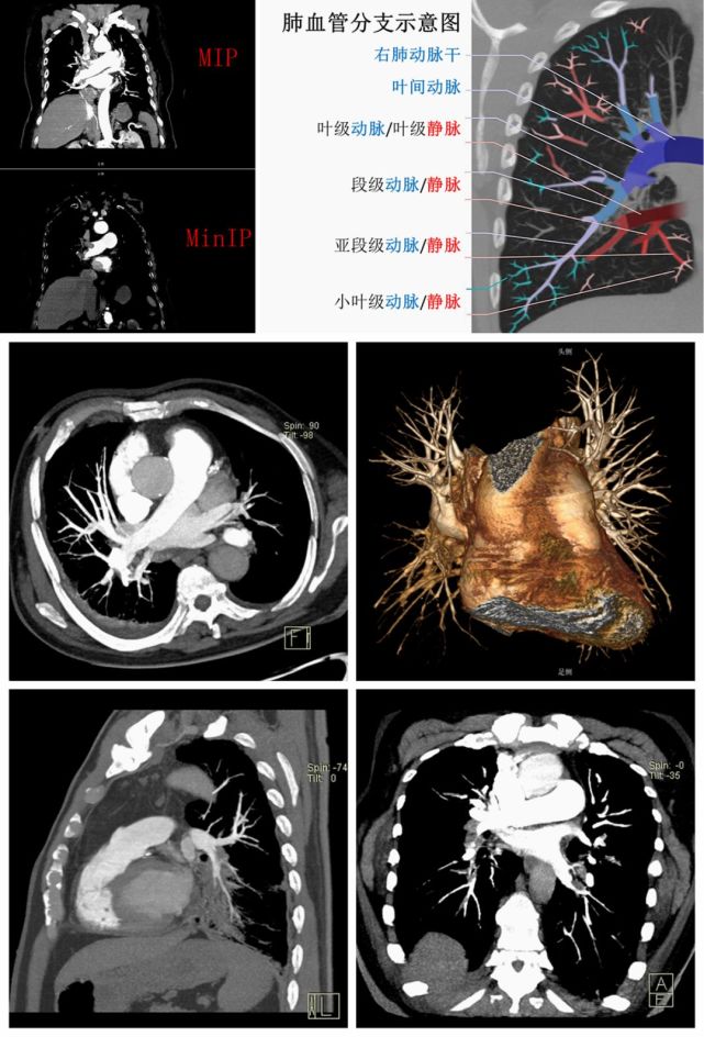 肺动脉 cta 不会看?这篇教你轻松诊断肺栓塞!