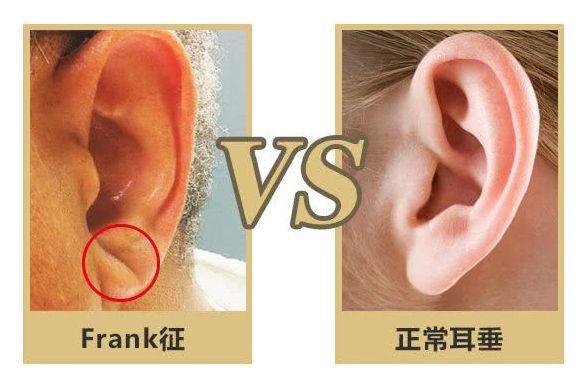 耳垂有折痕预示会得冠心病 Frank征真的有科学依据吗 腾讯新闻