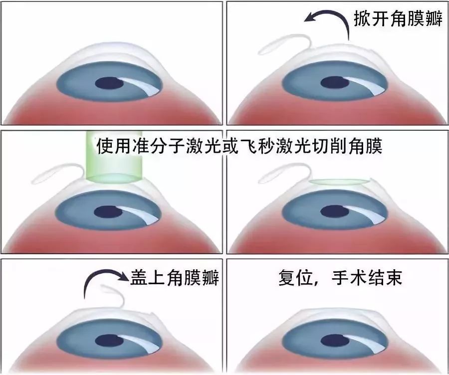 一周告别高度近视 真人记录icl 眼部手术全过程 腾讯新闻