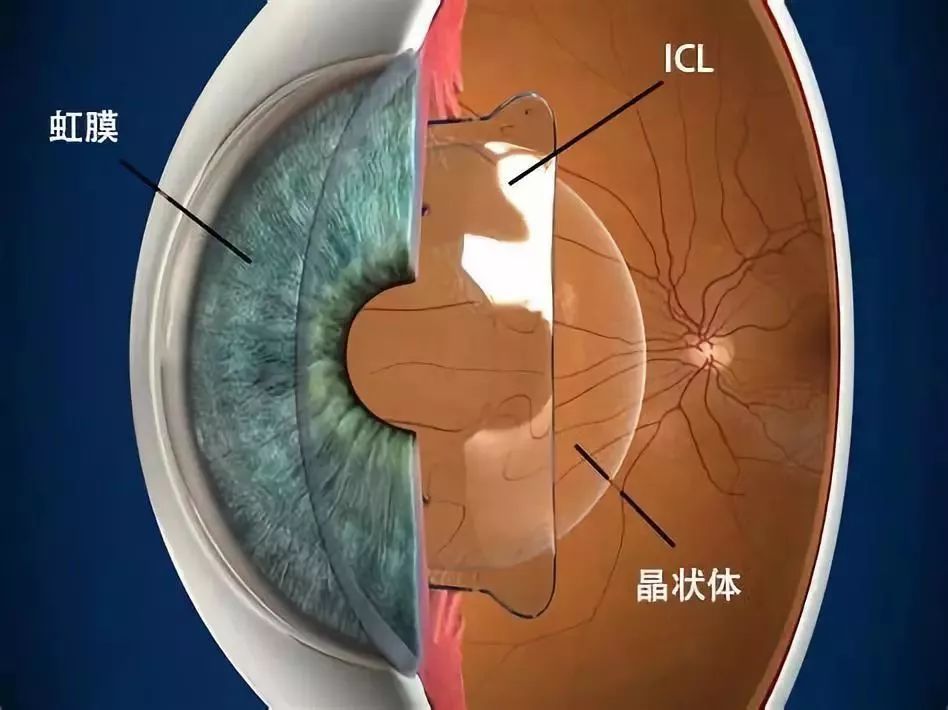 一周告别高度近视 真人记录icl 眼部手术全过程 腾讯新闻