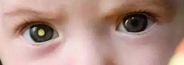 90后单眼女教师惊艳网友让她单眼失明的到底是什么病