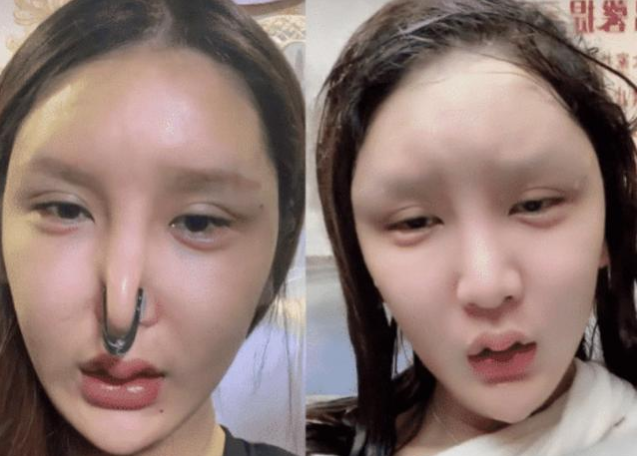 女子花86万整容失败?曾经相貌曝光后,网友:整容医生也不容易