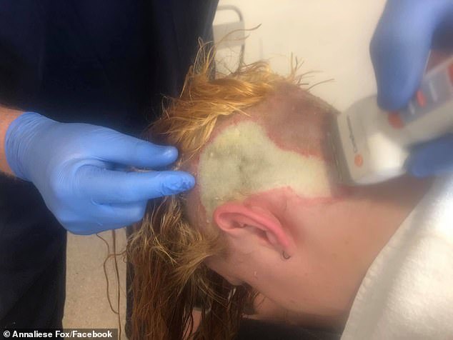 女孩自己动手漂白染发造成三度化学灼伤 一半头发都掉了还得植皮 腾讯新闻