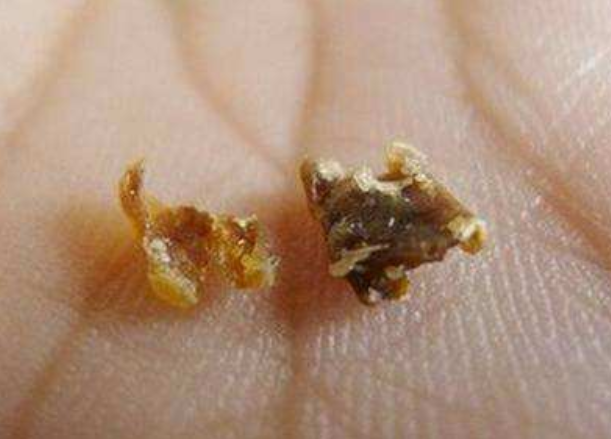 耳屎多了该不该掏?