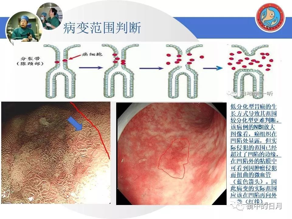 經典病例詳解:早期胃癌內鏡診治流程