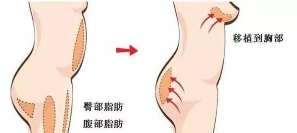 自体脂肪隆胸一个月后小了不要慌 抽脂填胸变小是有原因的 腾讯新闻