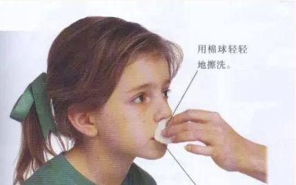 鼻出血怎么办?教你在家里自己解决自己治疗