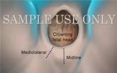 会阴侧切缝合术分步骤图片视频讲解
