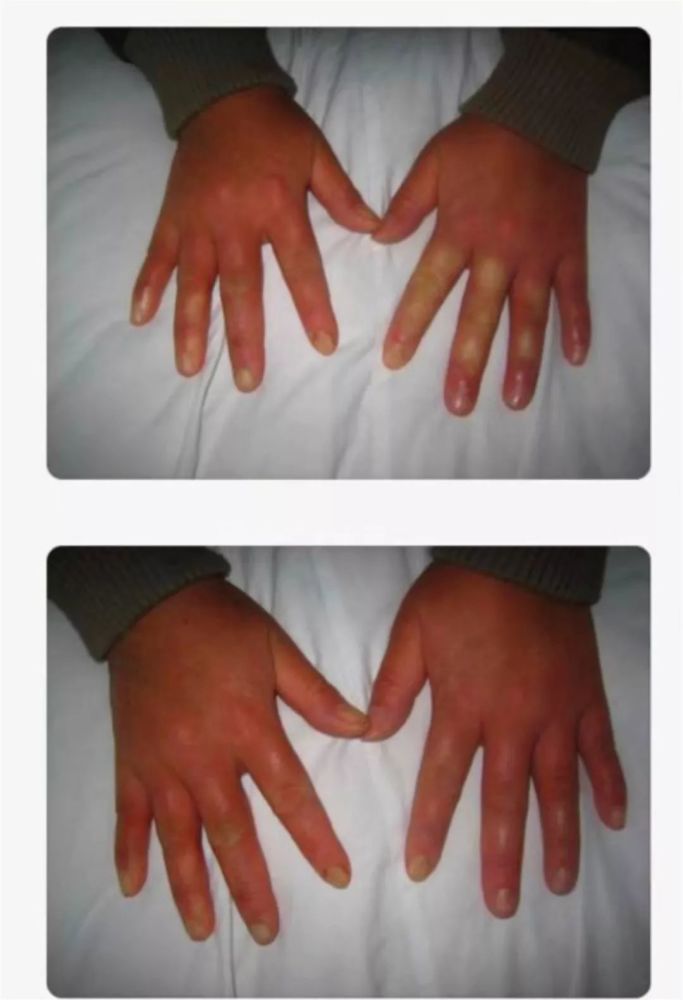 明显或顽固的雷诺现象,通常是合并有混合性结缔组织病或硬皮病倾向