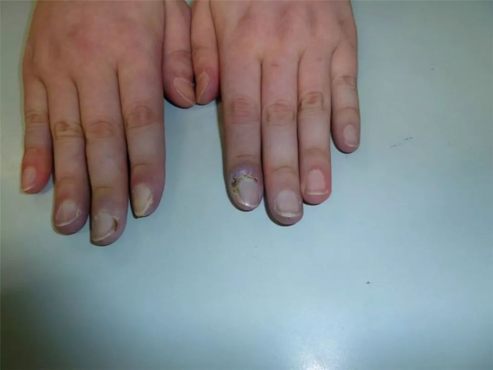 天变冷手指冰凉苍白变紫发黑千万要小心