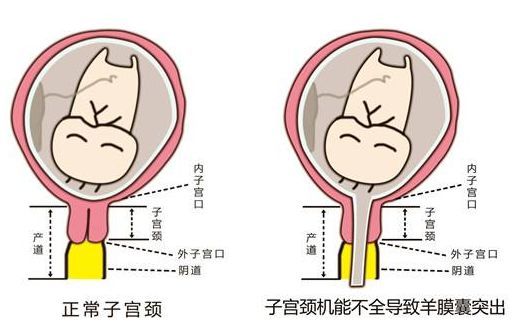 8厘米,就被称为过短,宫颈管过短会有早产的风险